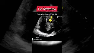 LA Myxoma #Echocardiography #heart
