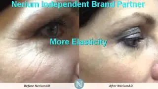Should I Get Botox San Antonio | Nerium Better Than Botox  | 210-305-7833