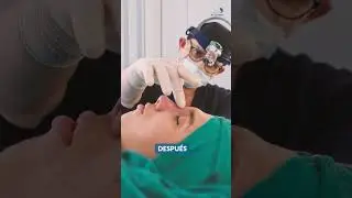 Rinoplastia (resultados) - Dr. Julio Hern&aacute;ndez / Cirujano Pl&aacute;stico