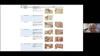 SALVE Classification for alcohol-related liver disease - Prof Martin Hale