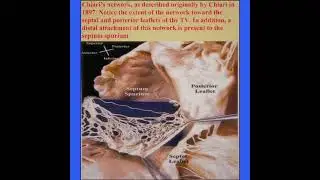Chiari Network  Echocardiography