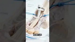 How Surgeons Rebuild a Torn Achilles Tendon
