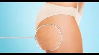What is Water Retention and How to Reduce It? | Beat Bloating & Cellulite Naturally