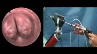 Camera Pivoting Fulcrum Effect TURP Prostate resection