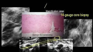 Fibroadenoma   Copy  Part I   Copy