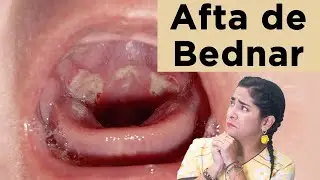 Afta de bednar