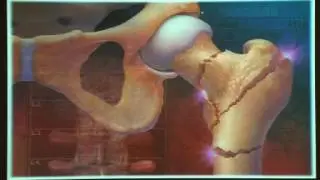 Cancer Therapy-Induced Bone Disease: A Smilow Cancer Hospital Approach?