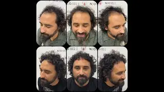 Otro resultado mas impresionante para el equipo de NEO Injerto Capilar. Pelo rizado...tambi&eacute;n&iexcl;&iexcl;&iexcl;&iexcl;