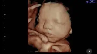 4D- High Definition Ultrasound- Inside View Olympia, WA