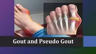 Most Expected MCQs on Gout & Pseudogout #gout #calcium #aiapget #jointpain #nursing #neet #mcqs #tip