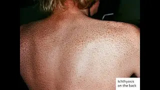 ichthyosis skin scaling; persistent dryness, scaling, giving the skin a &ldquo;fish scale&rdquo; appearance