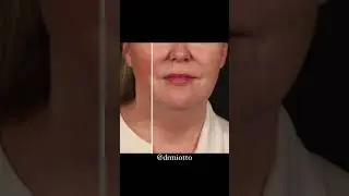 Turning back time with the deep plane face and neck lift.