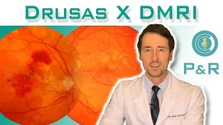 Quem tem drusas, tem degeneração macular? Drusas e a DMRI.