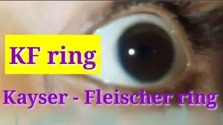 Kayser - Fleischer ring : Wilson's  disease