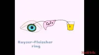 Wilson's  Disease 🌼 #Kayser_Fleischer_Ring 💥  #medicine 💊   #mediholic 🍂