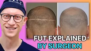 FUT Hair Transplant Explained by Surgeon