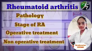 Rheumatoid arthritis|| pathology|| treatment of RA || orthopaedic