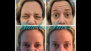 Microneedling with PRP Chandler - Flawless Faces