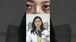 How to treat under eye bags | Under eye bags treatment #undereyebags #shorts