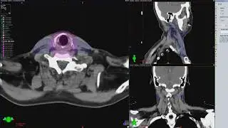 VMAT for Head and Neck Planning Radiotherapy