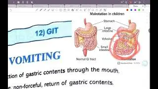 Ch3 ped 2: GIT (medicine $Pediatric 42 )