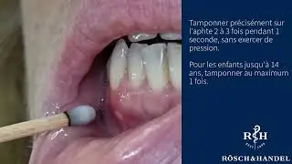 Traitement rapide des aphtes avec du nitrate d'argent
