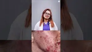 মাসিকের আগে মুখে ব্রণ কেন হয় ও দূর করার উপায় | Period Acne Treatment Bangla