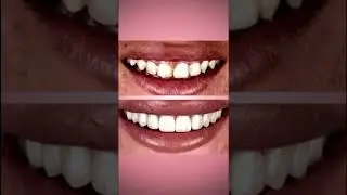 Dental Turkey  #beforeandafter #dentalturkey  #happyesthetic