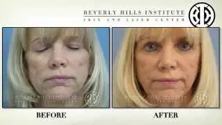 Sculptra for facial volume loss