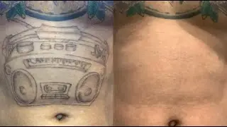 Best Laser Tattoo Removal | Full Process + Healing + Cost | San Antonio - Live Oak TX