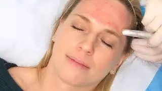 Microneedling with PRP by Dr. Overton at Mint Integrative Health