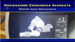Navigazione Avanzata Protesi Anca Mininvasiva