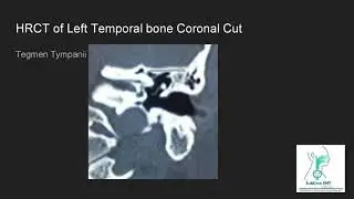 HRCT Temoral Bone Coronal