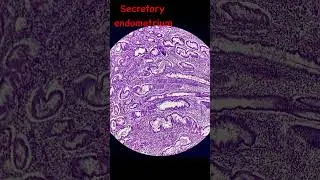 Endometrium #pathology #mbbs
