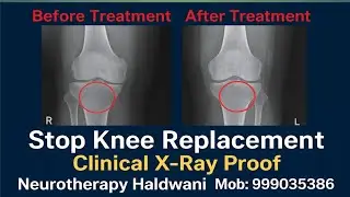 Immediate end to knee pain #knee pain treatment/#knee Gap treatment/#neurotherapy haldwani