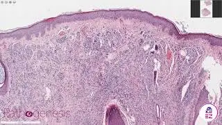 Intradermal Nevus