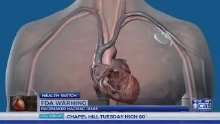 Dr. Campbell: Certain pacemakers may be able to be hacked, FDA warns