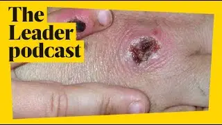 Monkeypox outbreak in London explained... The Leader podcast
