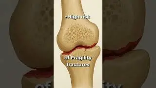 Osteopenia = T-score 0 to -2.5 📉Osteoporosis = below -2.5 ⚠️ Fragile bone alert! #bonehealth