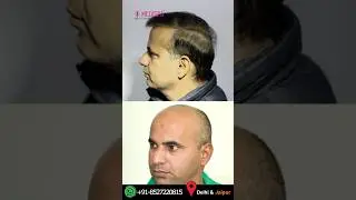 11,000 Grafts in 3 Sessions for Grade 6 Baldness &ndash; FUE Only? 🤔 Unbelievable Results! | Dr. Suneet
