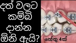 දත් වලට කම්බි දාන්නේ ඇයි?? l  Braces for teeth @dentistsdiary2950