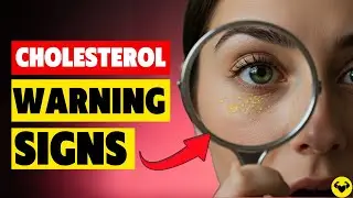 6 Warning Signs of Bad Cholesterol You Must Spot Before a Stroke