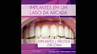 RECONSTRU&Ccedil;&Atilde;O DO SORRISO COM ZIRC&Ocirc;NIA E IMPLANTE DENT&Aacute;RIO