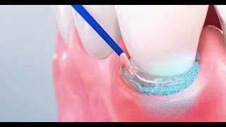 Pocket-X&reg; Gel - Anwendung