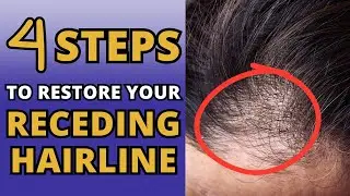 Can Braiding Cause Receding Hairline? 4 Steps To Restore Your Edges!