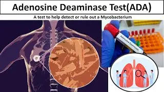 Adenosine Deaminase Test - Clear overview #Tuberculosis  #ADAtest#ADA#mls#medilabacademy.