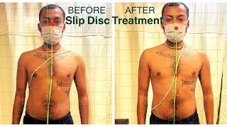 Slip Disc L4-L5 Treatment || Lateral Shift || Back Pain Treatment || #chiropractor @ 7533066301
