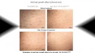 How To Remove unwanted hair permanently For Men