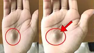 Dad Found This Strange Lump On His Palm. Then A Scan Revealed The True Cause Of His Pain.