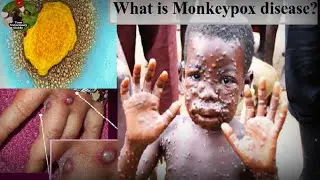 Monkey pox Disease || viral disease #viraldisease #monkeypox #monkeypoxtreatment